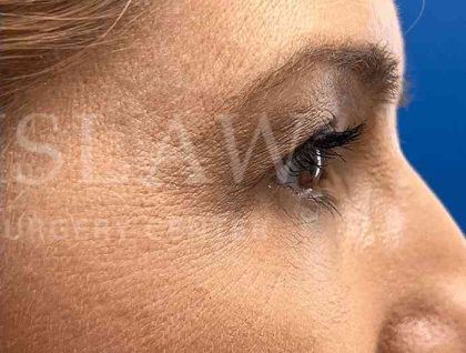 Lower Blepharoplasty Before & After Patient #821