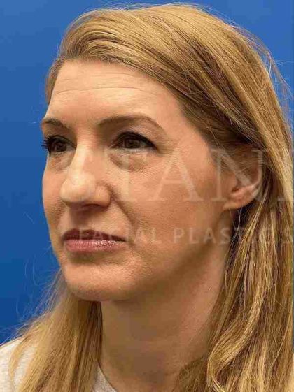 Lower Blepharoplasty Before & After Patient #821