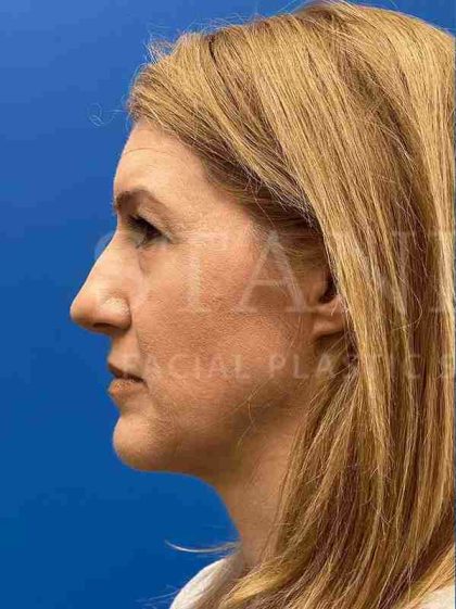 Lower Blepharoplasty Before & After Patient #821
