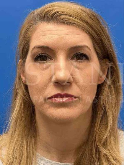 Lower Blepharoplasty Before & After Patient #821
