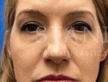 Lower Blepharoplasty Before & After Patient #821