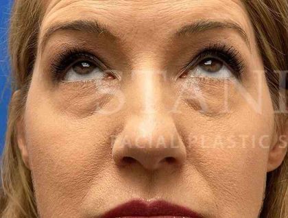 Lower Blepharoplasty Before & After Patient #821