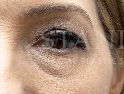 Lower Blepharoplasty Before & After Patient #821