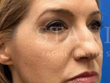 Lower Blepharoplasty Before & After Patient #821