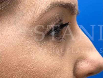 Lower Blepharoplasty Before & After Patient #821