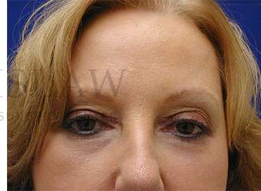 Lower Blepharoplasty Before & After Patient #901