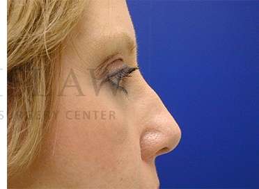 Lower Blepharoplasty Before & After Patient #901