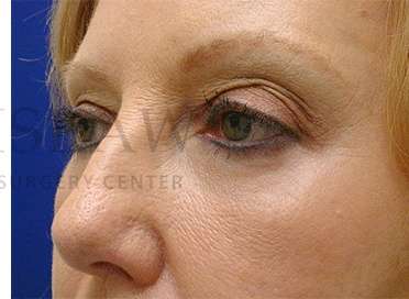 Lower Blepharoplasty Before & After Patient #901