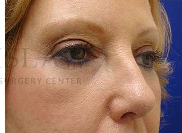 Lower Blepharoplasty Before & After Patient #901