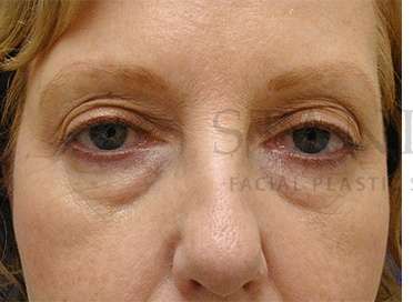 Lower Blepharoplasty Before & After Patient #901