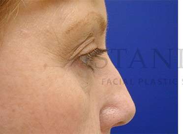Lower Blepharoplasty Before & After Patient #901