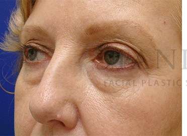 Lower Blepharoplasty Before & After Patient #901