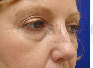 Lower Blepharoplasty Before & After Patient #901