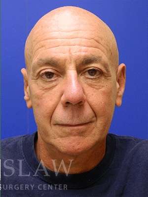 Lower Blepharoplasty Before & After Patient #892
