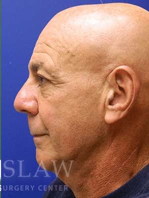 Lower Blepharoplasty Before & After Patient #892