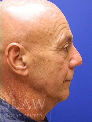 Lower Blepharoplasty Before & After Patient #892