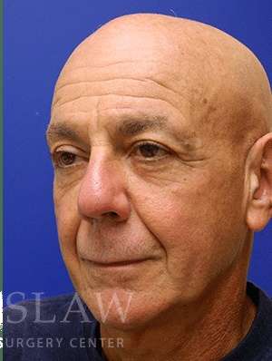 Lower Blepharoplasty Before & After Patient #892