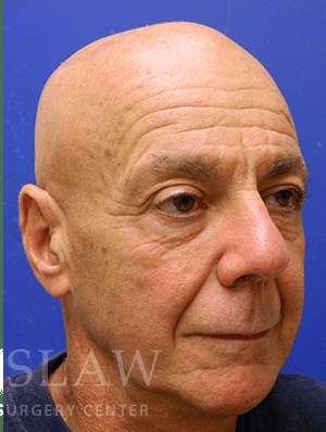 Lower Blepharoplasty Before & After Patient #892