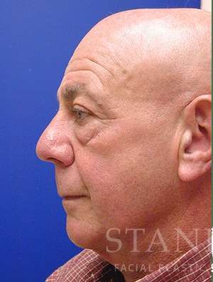 Lower Blepharoplasty Before & After Patient #892