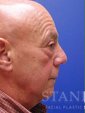 Lower Blepharoplasty Before & After Patient #892