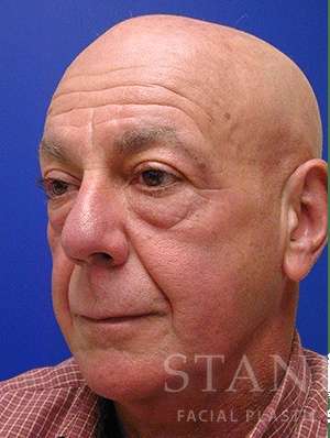 Lower Blepharoplasty Before & After Patient #892