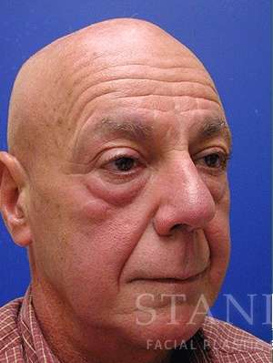Lower Blepharoplasty Before & After Patient #892