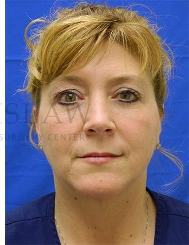 Lower Blepharoplasty Before & After Patient #881