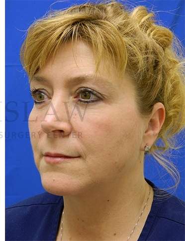 Lower Blepharoplasty Before & After Patient #881