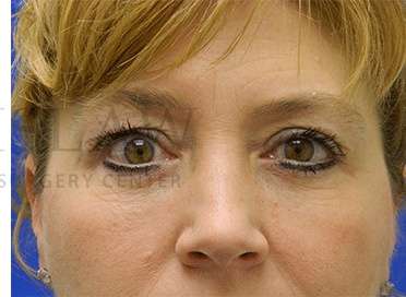 Lower Blepharoplasty Before & After Patient #881