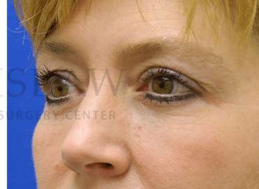 Lower Blepharoplasty Before & After Patient #881