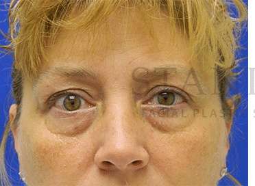 Lower Blepharoplasty Before & After Patient #881