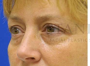 Lower Blepharoplasty Before & After Patient #881