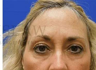 Lower Blepharoplasty Before & After Patient #868