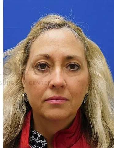 Lower Blepharoplasty Before & After Patient #868