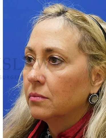 Lower Blepharoplasty Before & After Patient #868