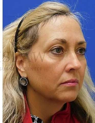 Lower Blepharoplasty Before & After Patient #868