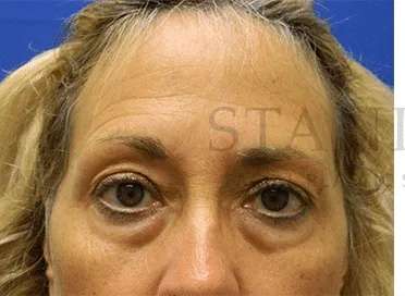 Lower Blepharoplasty Before & After Patient #868