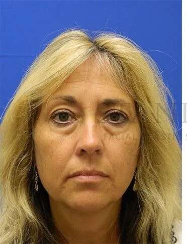 Lower Blepharoplasty Before & After Patient #868