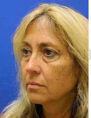 Lower Blepharoplasty Before & After Patient #868