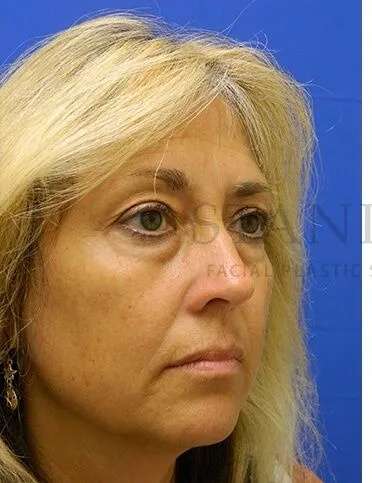 Lower Blepharoplasty Before & After Patient #868