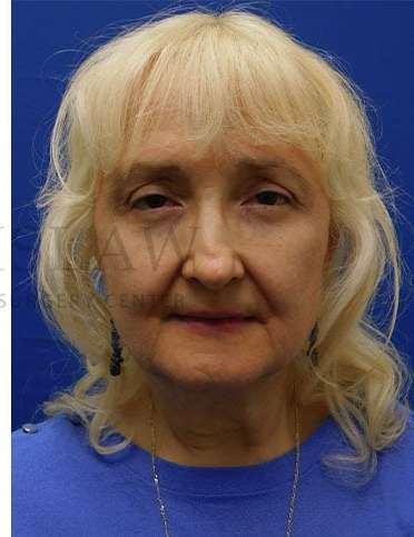 Lower Blepharoplasty Before & After Patient #859