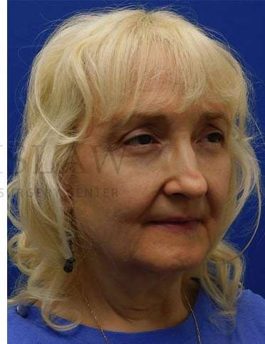 Lower Blepharoplasty Before & After Patient #859
