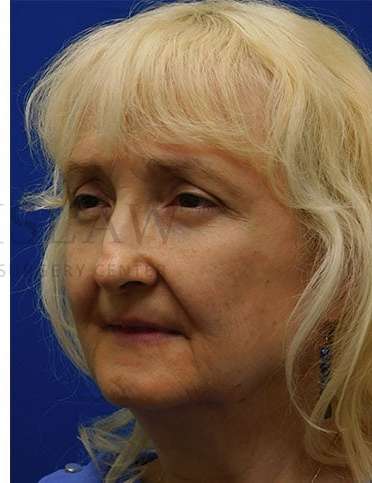Lower Blepharoplasty Before & After Patient #859