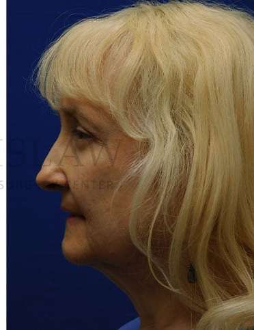 Lower Blepharoplasty Before & After Patient #859