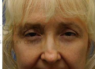 Lower Blepharoplasty Before & After Patient #859