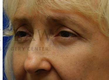 Lower Blepharoplasty Before & After Patient #859