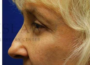Lower Blepharoplasty Before & After Patient #859