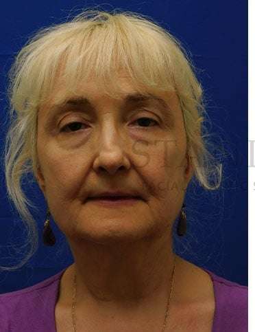 Lower Blepharoplasty Before & After Patient #859