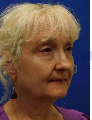 Lower Blepharoplasty Before & After Patient #859