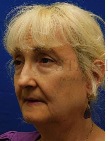 Lower Blepharoplasty Before & After Patient #859
